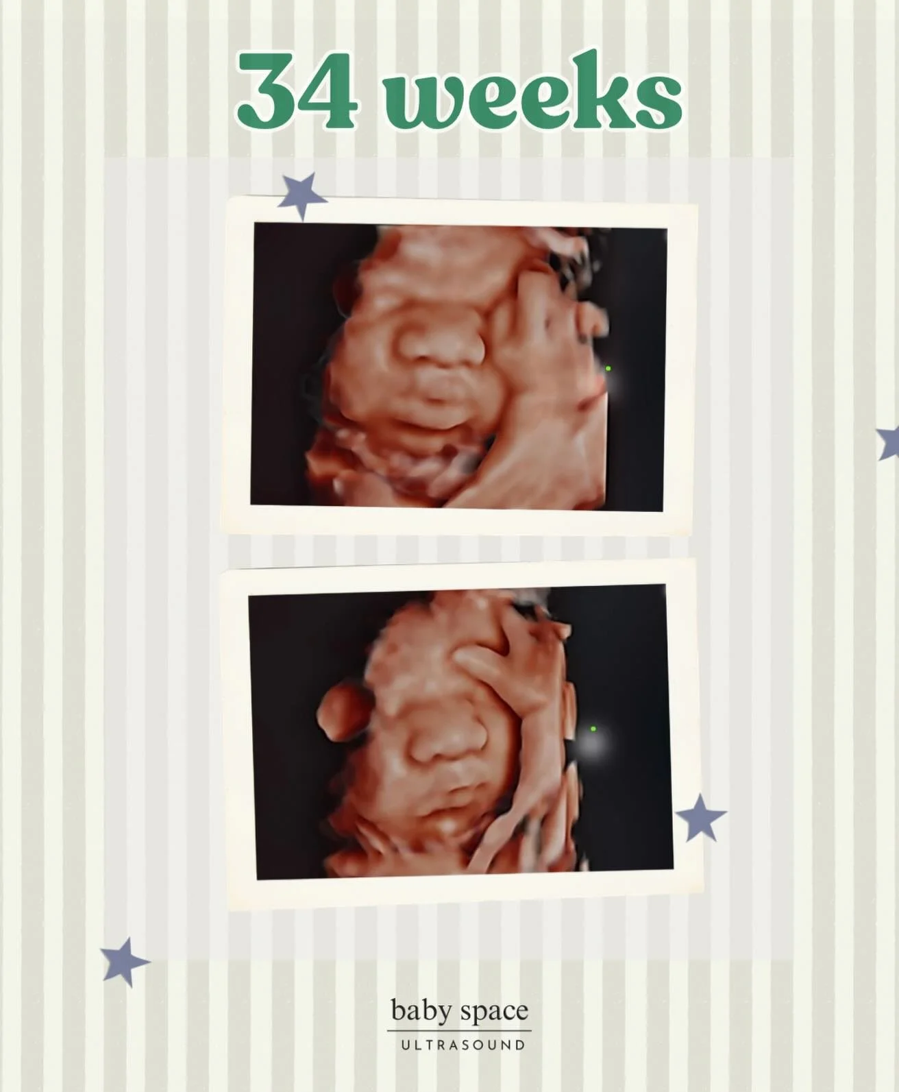 34 weeks and already stealing hearts 🥹🤍

We were SO impressed by this sweet baby, those chubby cheeks had us all in awe! 😍 It&rsquo;s moments like these that make what we do so special&hellip; getting to capture these tiny features before you meet