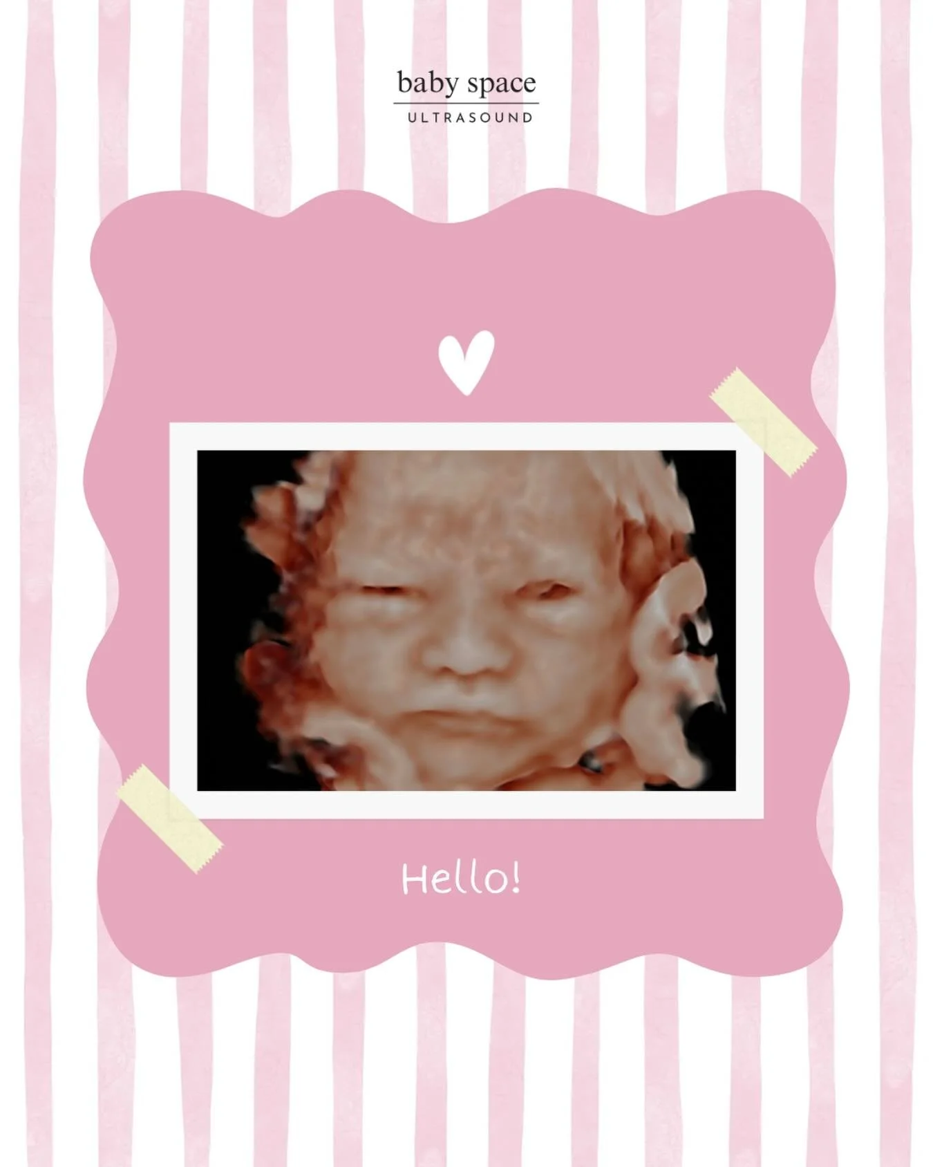✨ Hello, sweet baby girl! ✨

Just look at this precious little one with her eyes wide open for us! 💕 She was so curious and alert during her ultrasound session.

Did you know that babies can open their eyes while still in the womb during the third t