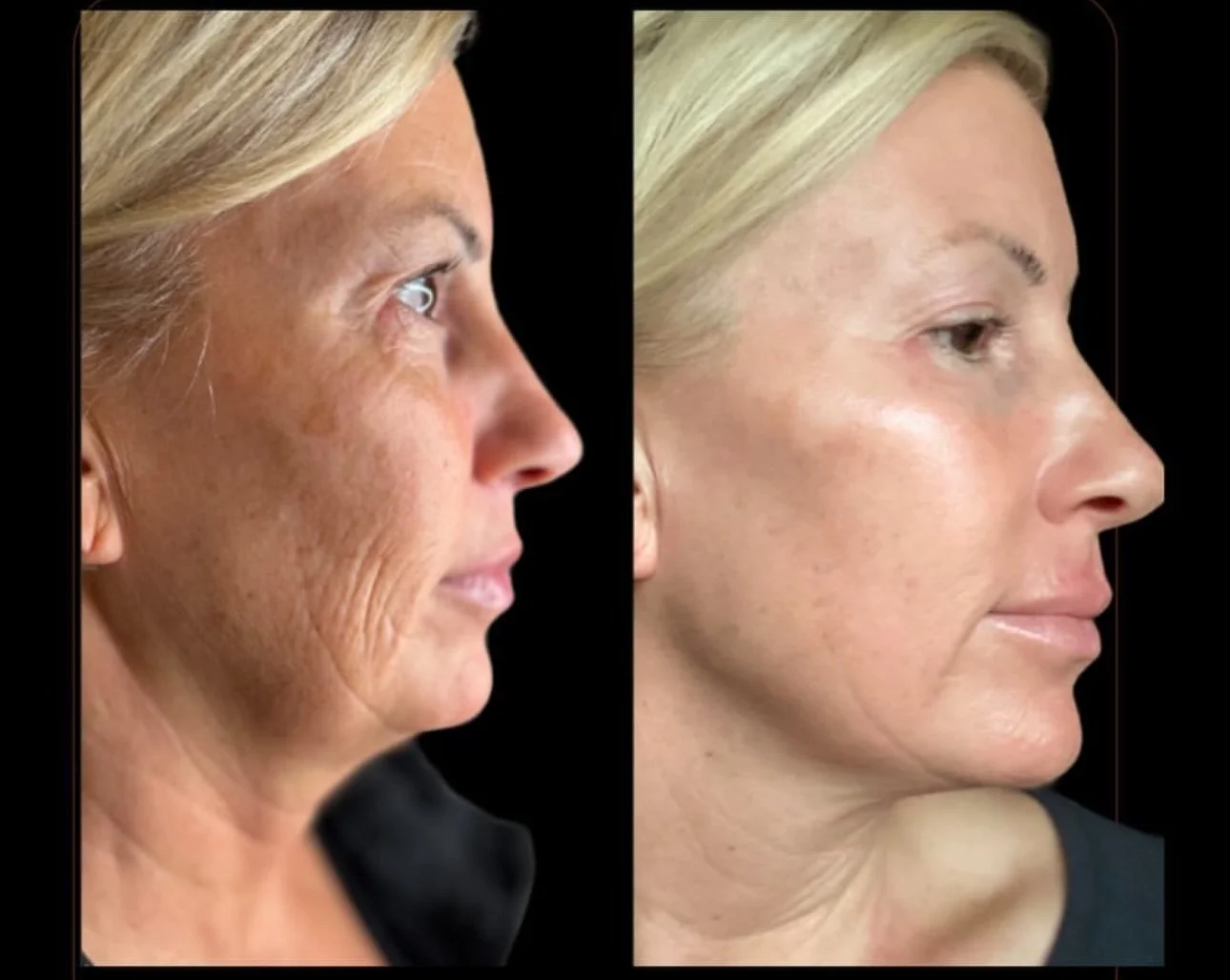 Side-by-side comparison of a woman's face before and after a skin treatment, showing reduced wrinkles and smoother skin.