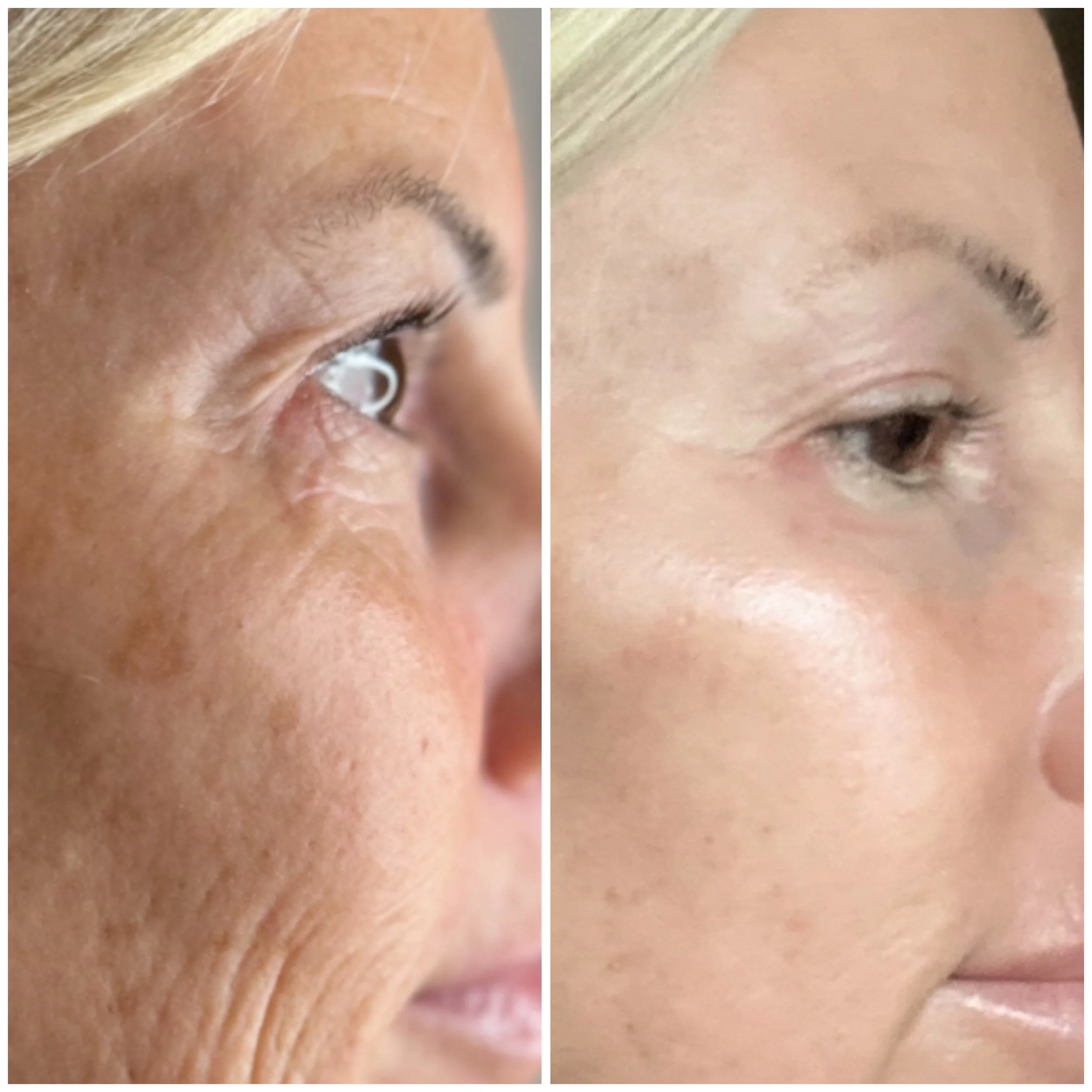 Side-by-side comparison of a woman's face before and after skin treatment, showing smoother, clearer skin on the right side.