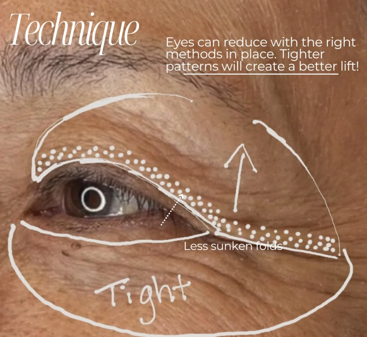 Fibroblast Plasma Lift vs. Blepharoplasty: The Science of Eyelid Skin Tightening
