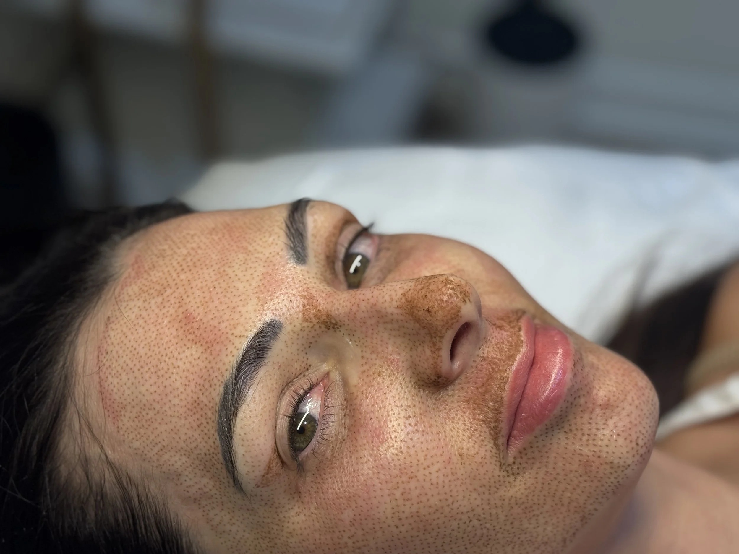 Why Fibroblast Isnβt Just a Service <3 Itβs Skin Alchemy