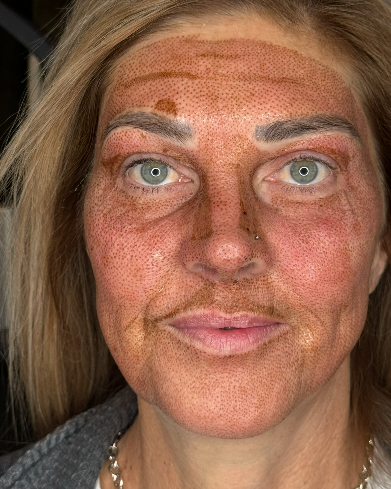 Steps Before Getting Fibroblast