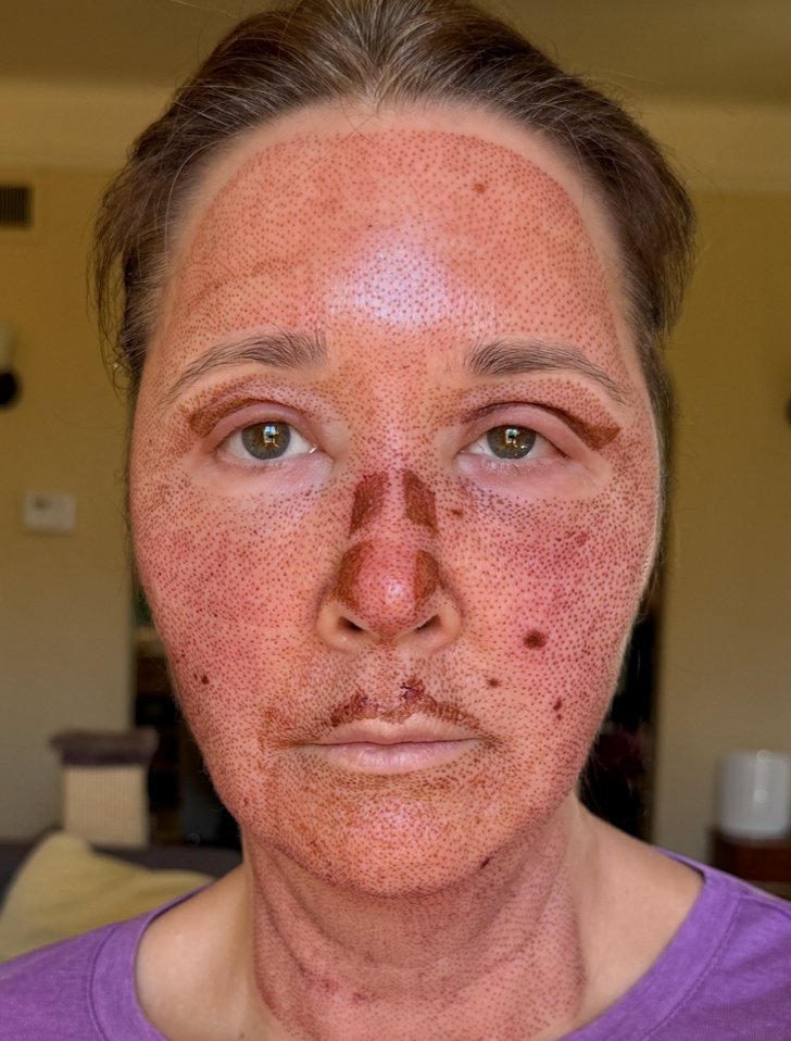 Why does swelling last 3-4 days with Fibroblast?