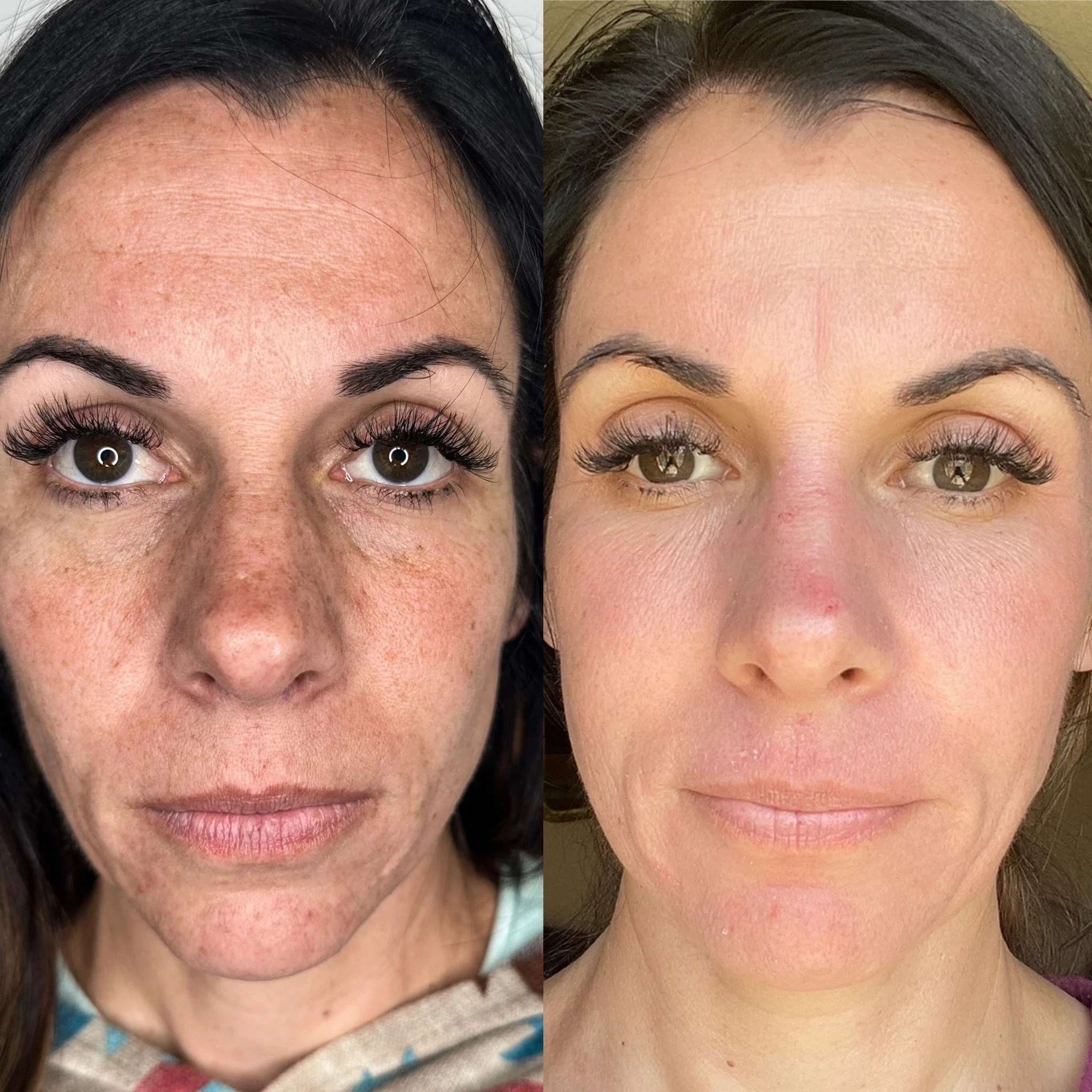 Fibroblast full face lift