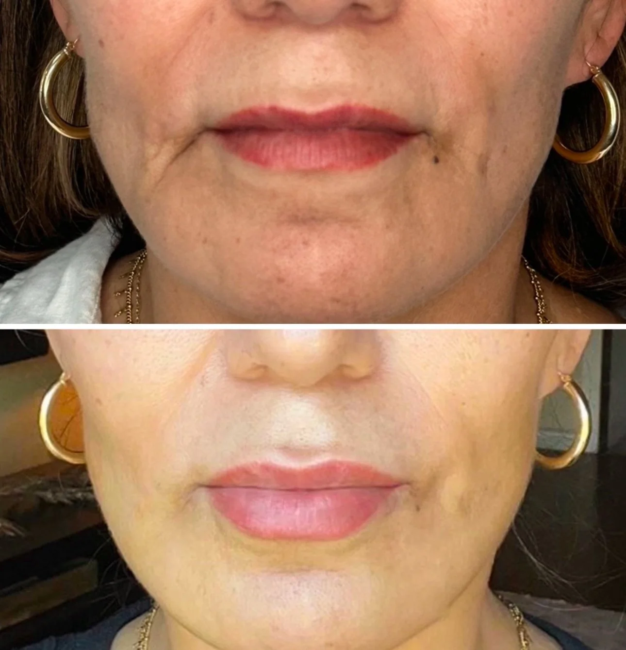 Comparison of a woman's face showing before and after cosmetic dental or facial aesthetic treatment, focusing on lips and skin texture.