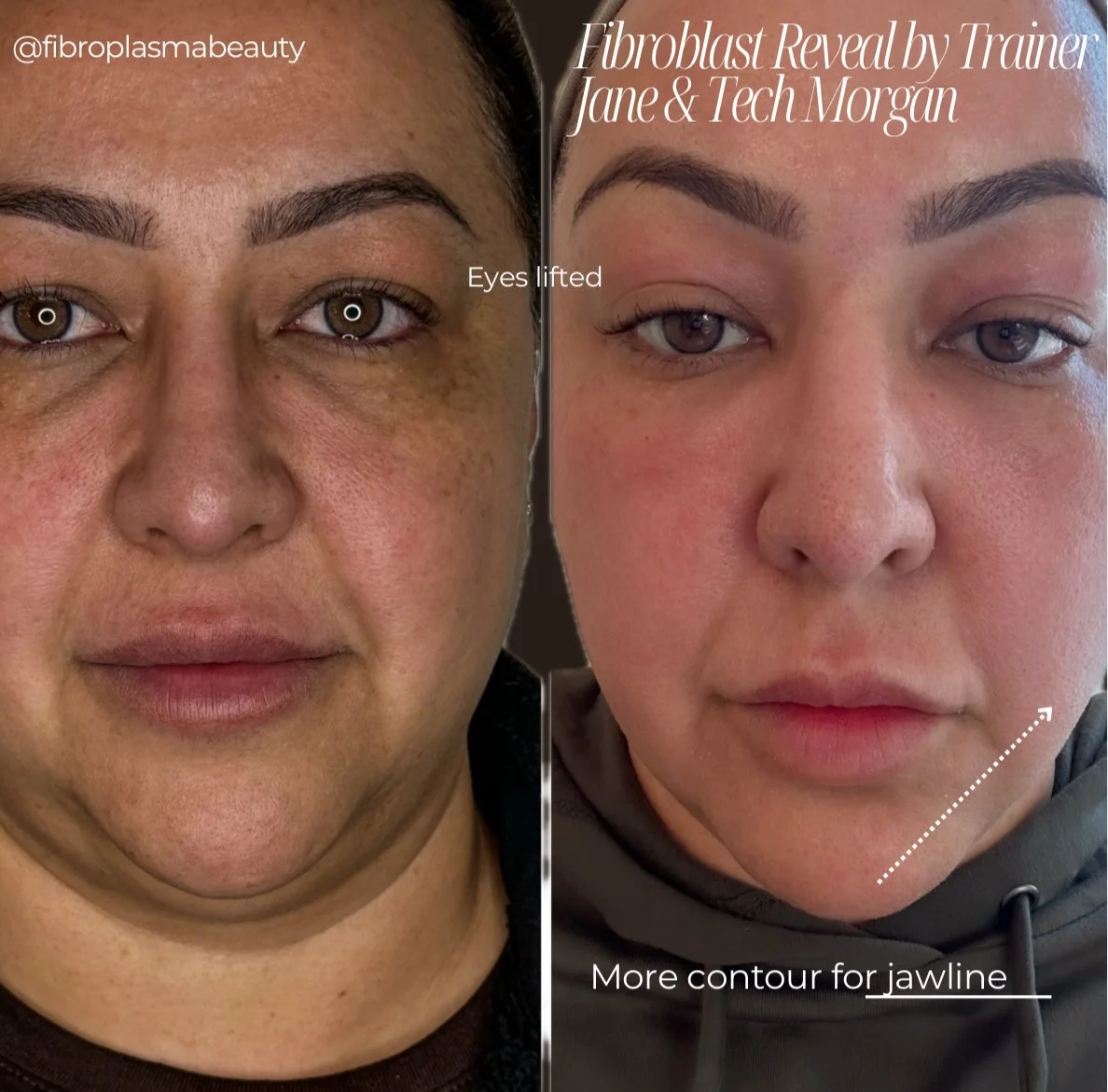 Side-by-side images showing a woman's face before and after a fibroblast treatment. The left image shows her with uneven skin tone and sagging eyelids, while the right image shows her with lifted eyes, smoother skin, and more contour for her jawline.