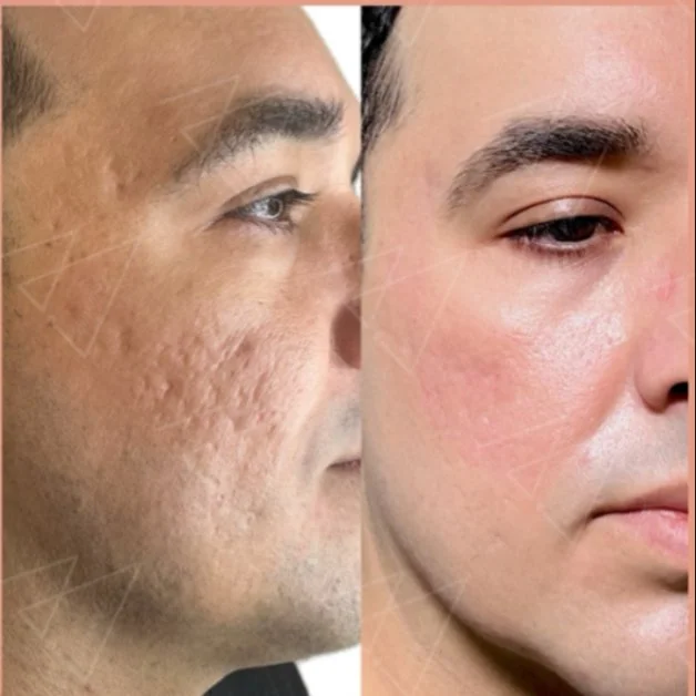Close-up comparison of a man's face showing skin improvement from rough, acne-prone skin on the left to smooth, clear skin on the right.