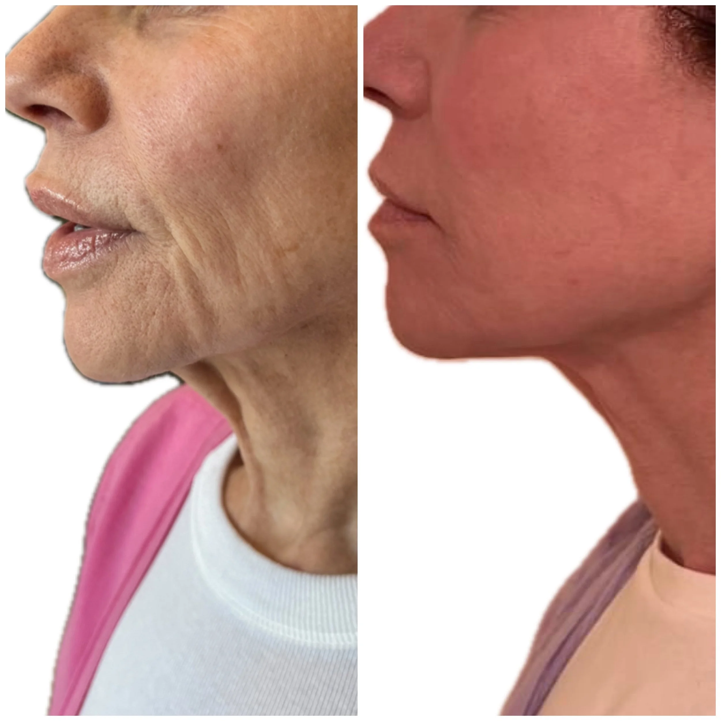Comparison of a woman's face before and after skincare treatment, showing improved skin texture and tone on the right.