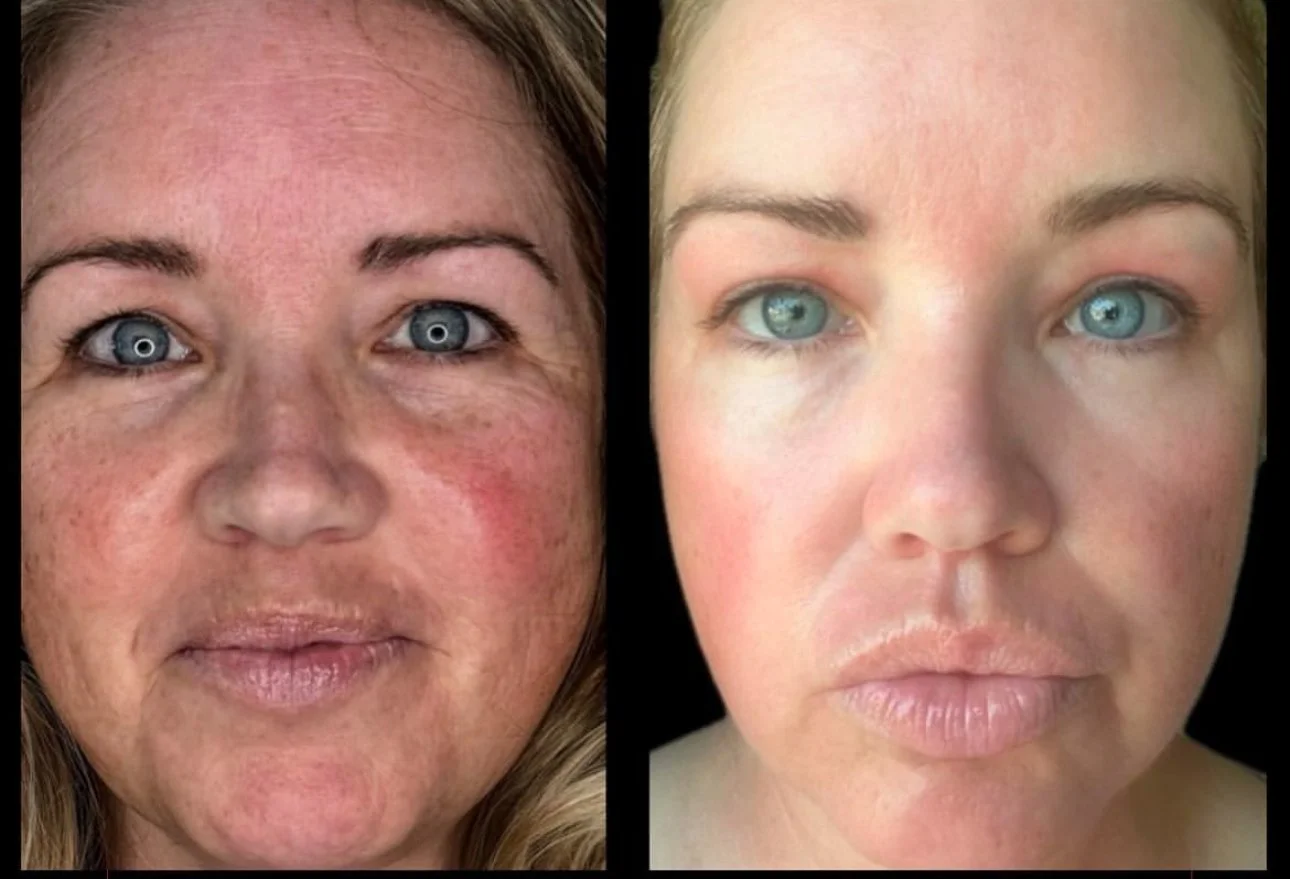 Side-by-side comparison of a woman's face before and after skincare treatment, showing reduced redness, freckles, and improved skin texture.