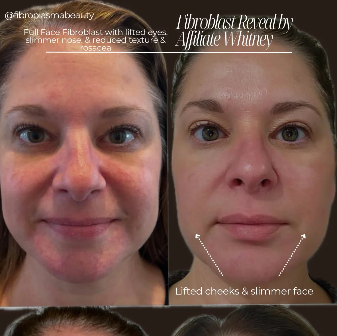 Comparison of before and after facial appearance showing results of fiberblast treatment. The before image shows a woman with red, textured skin, slightly drooping eyelids, and fuller cheeks. The after image shows the same woman with lifted cheeks, a