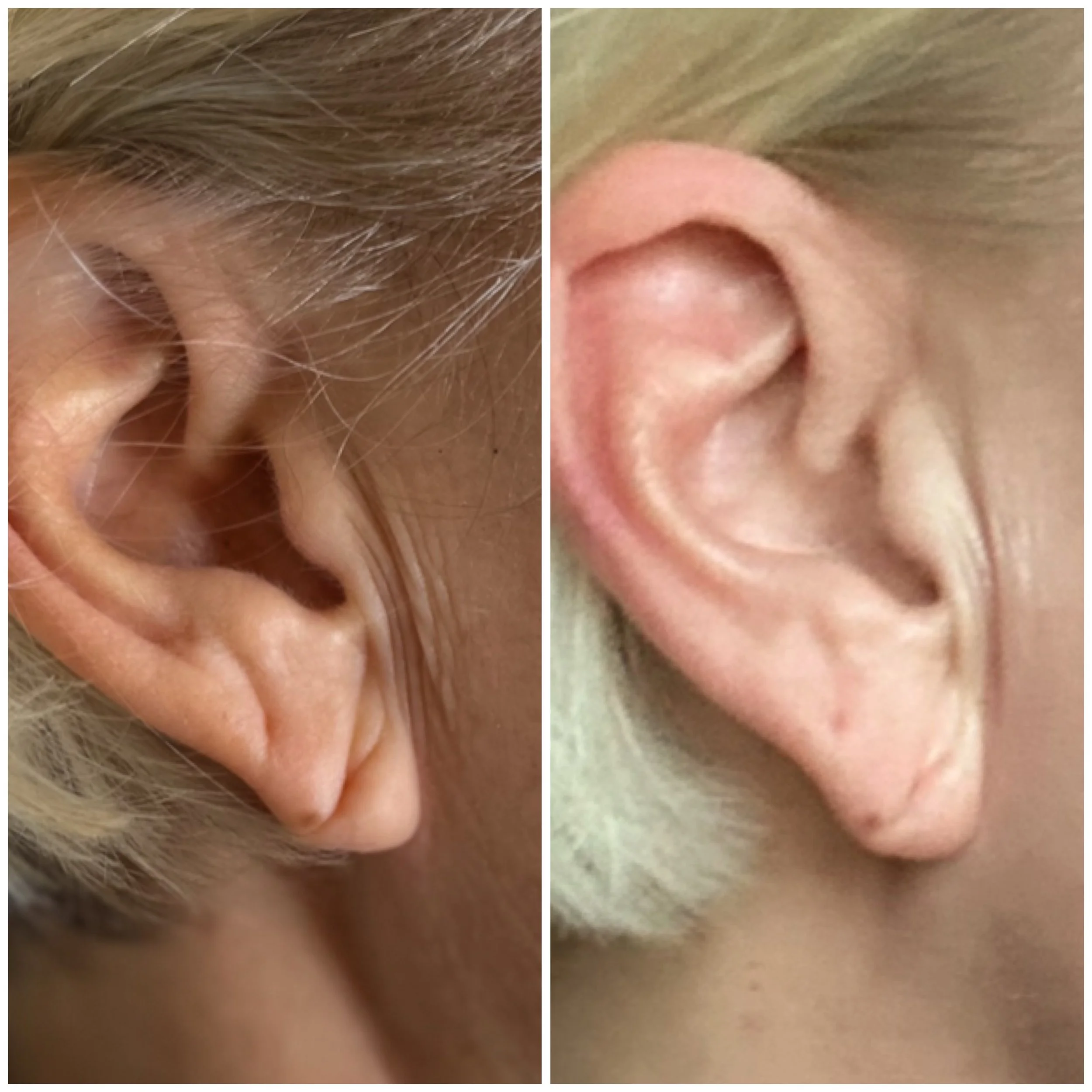 Comparison of two people's ears, one with darker skin and darker hair, and the other with lighter skin and blonde hair.