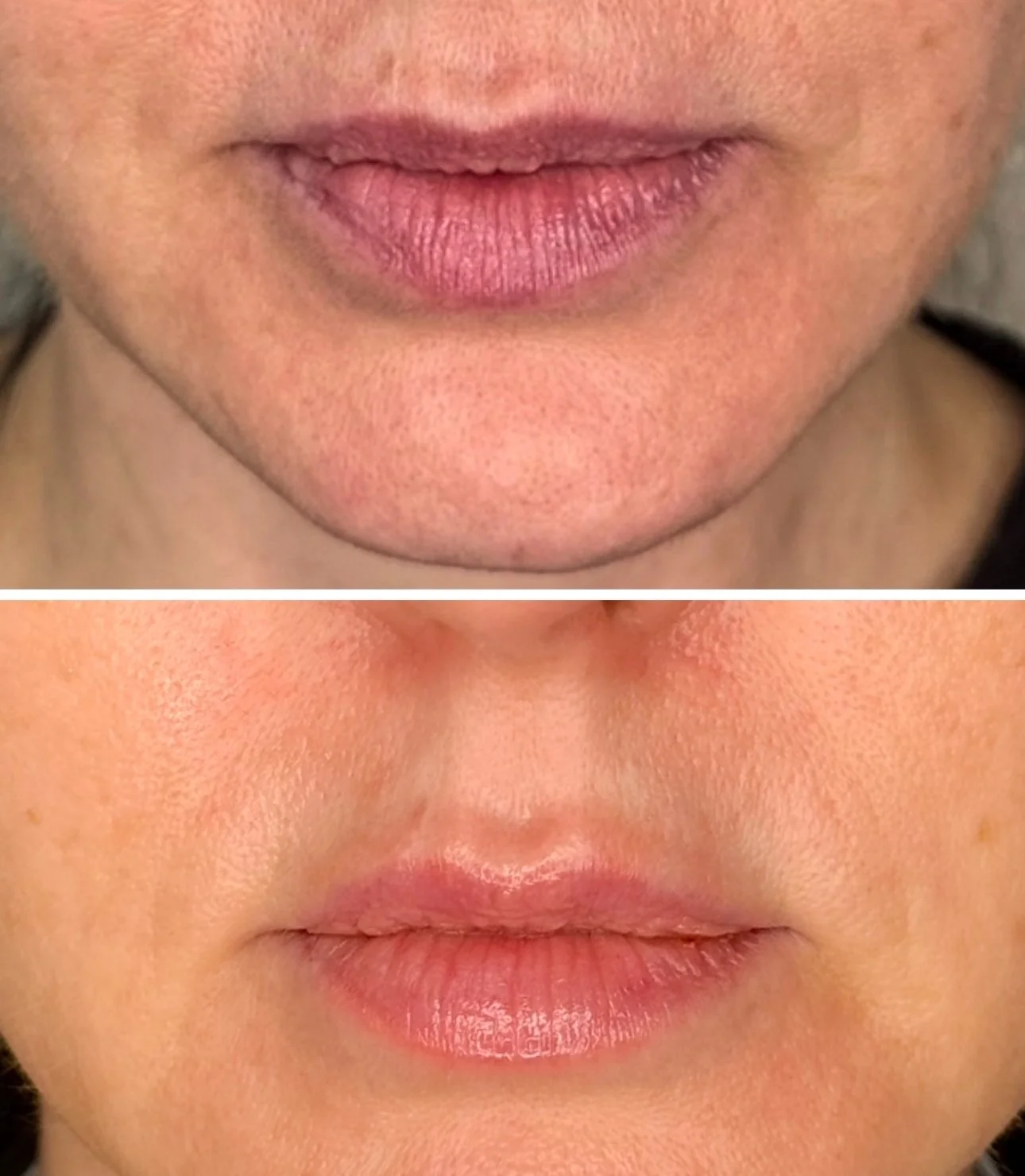 A side-by-side comparison of a person's lips before and after a cosmetic procedure. The top image shows lips with natural texture and slight dryness, while the bottom image displays smoother, more hydrated lips with a softer appearance.