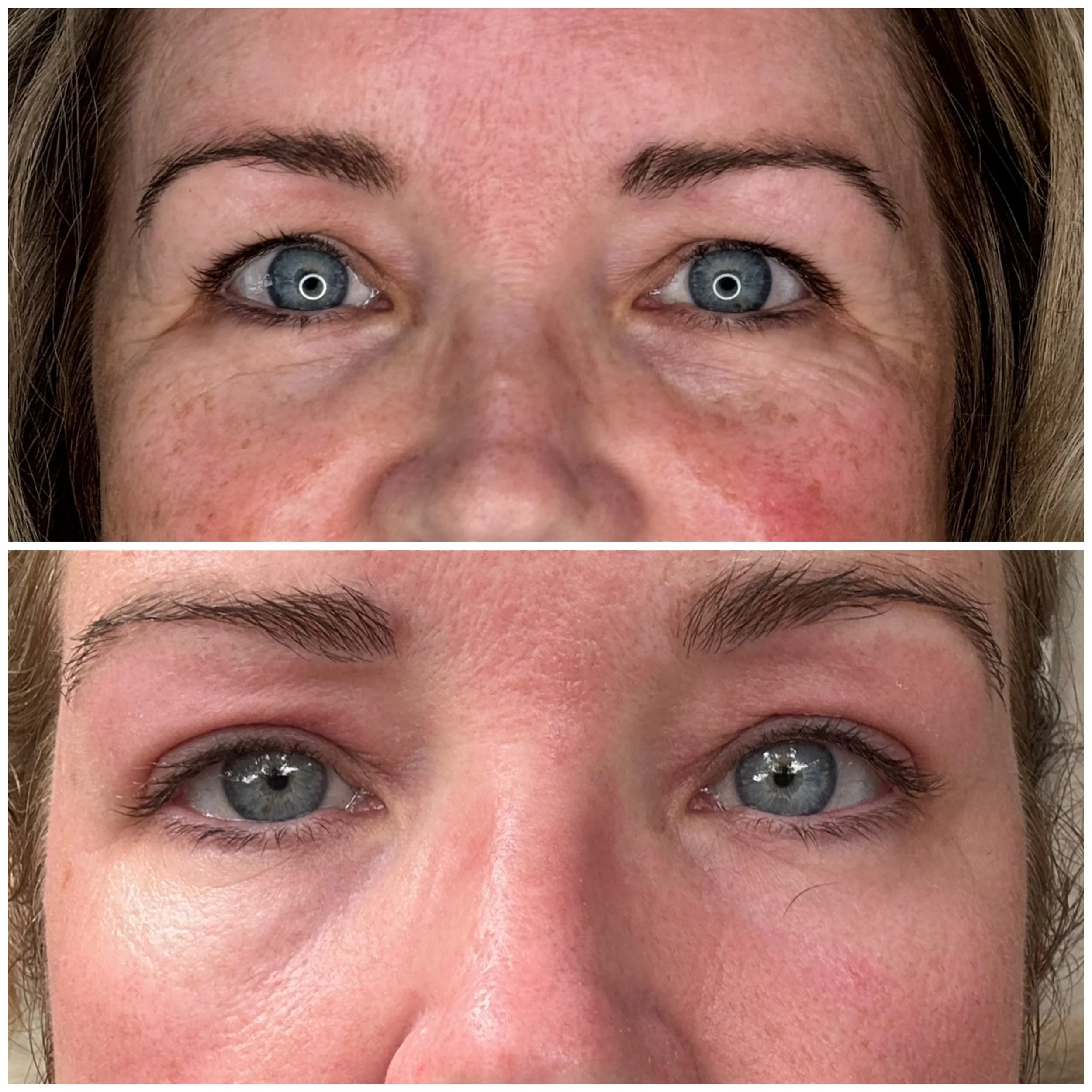 Close-up of a woman's face showing before and after cosmetic treatment around her eyes, with brighter skin and improved appearance in the after image.