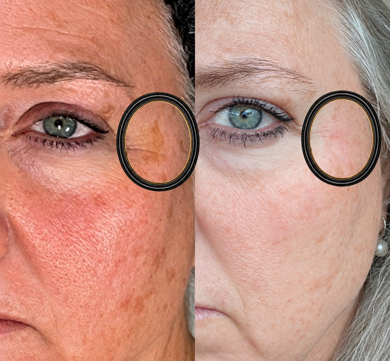 before and after of dark spot by her eye being removed