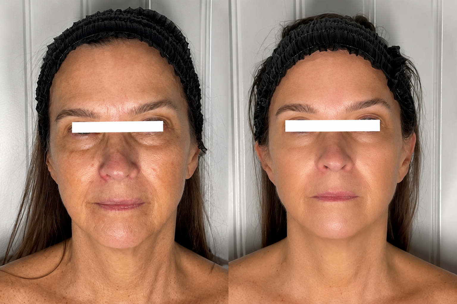 before and after showing smooth glowing skin
