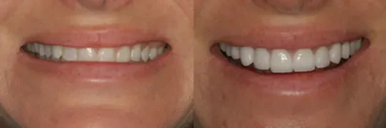 Veneers
