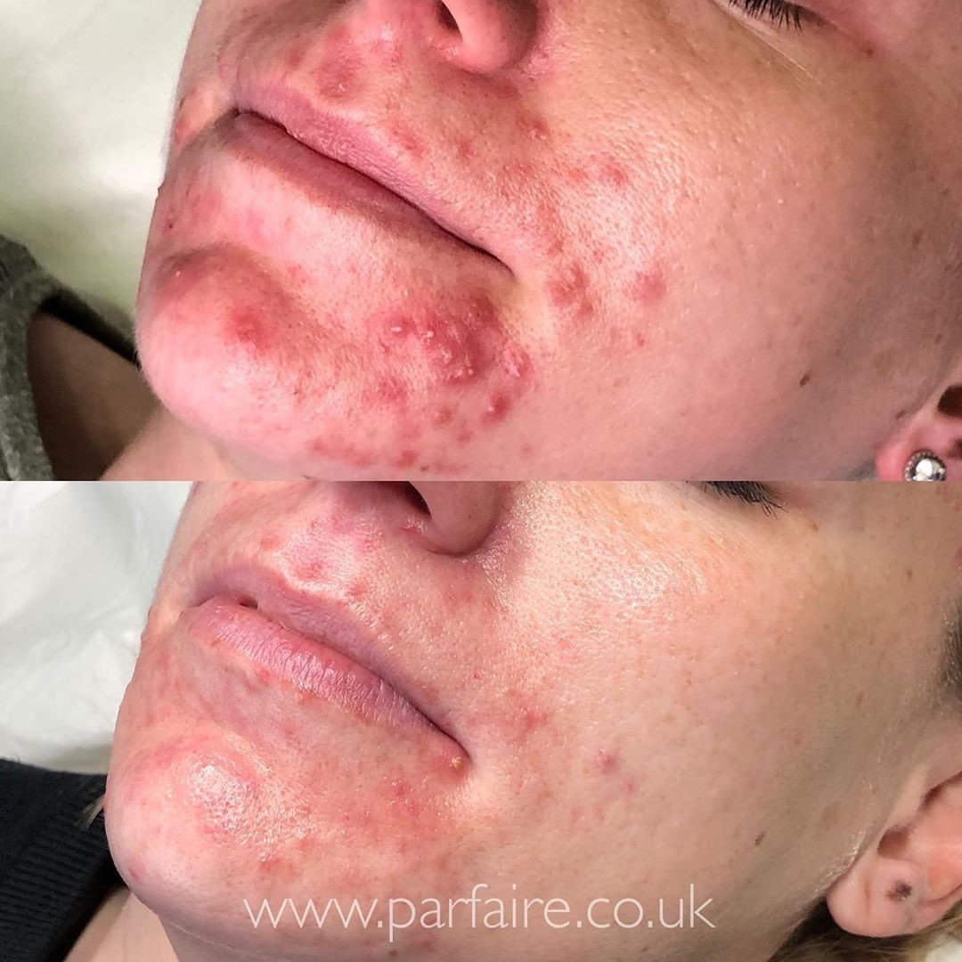 DERMALUX Before and After Images Acne.jpg