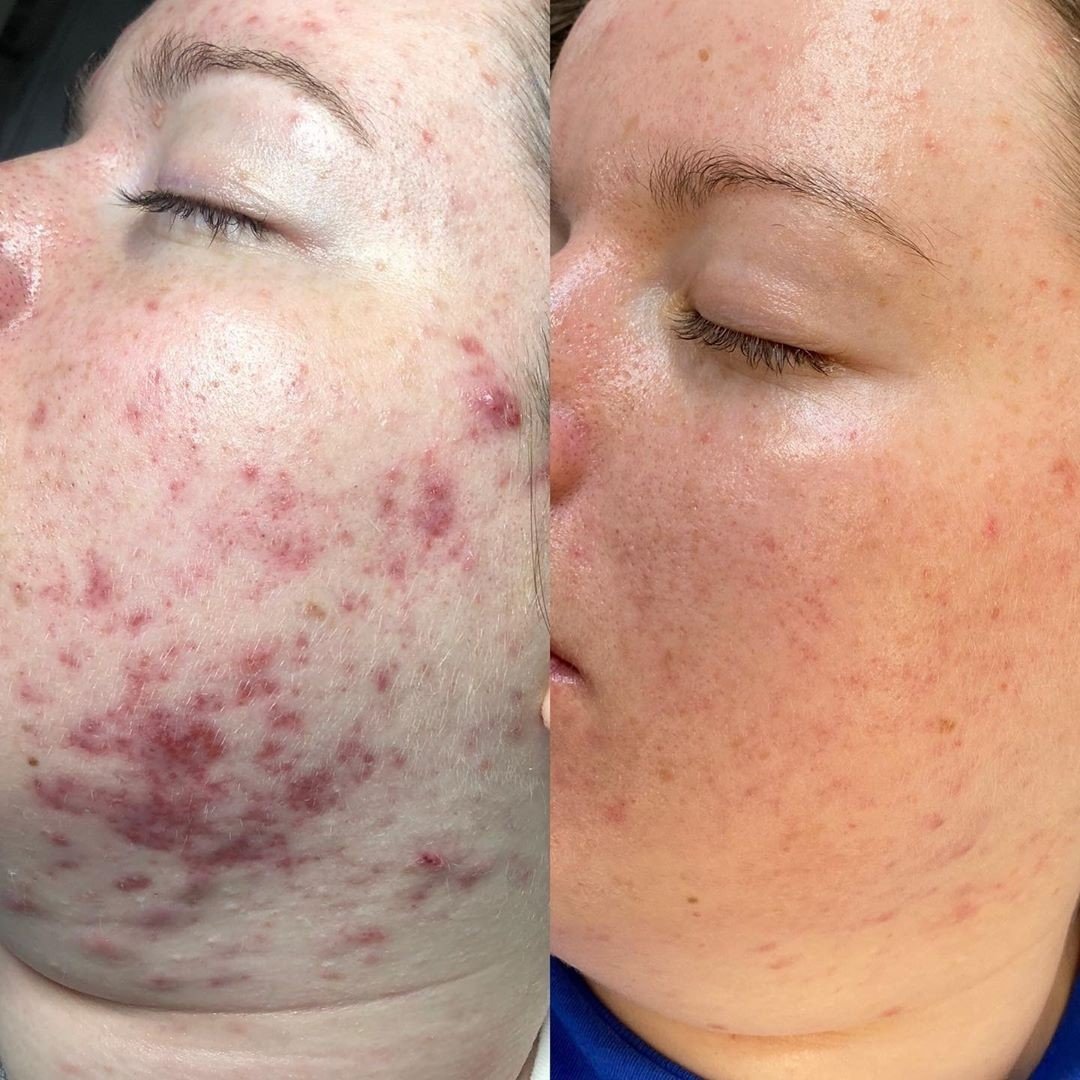 DERMALUX Before and After Images Acne2.jpg