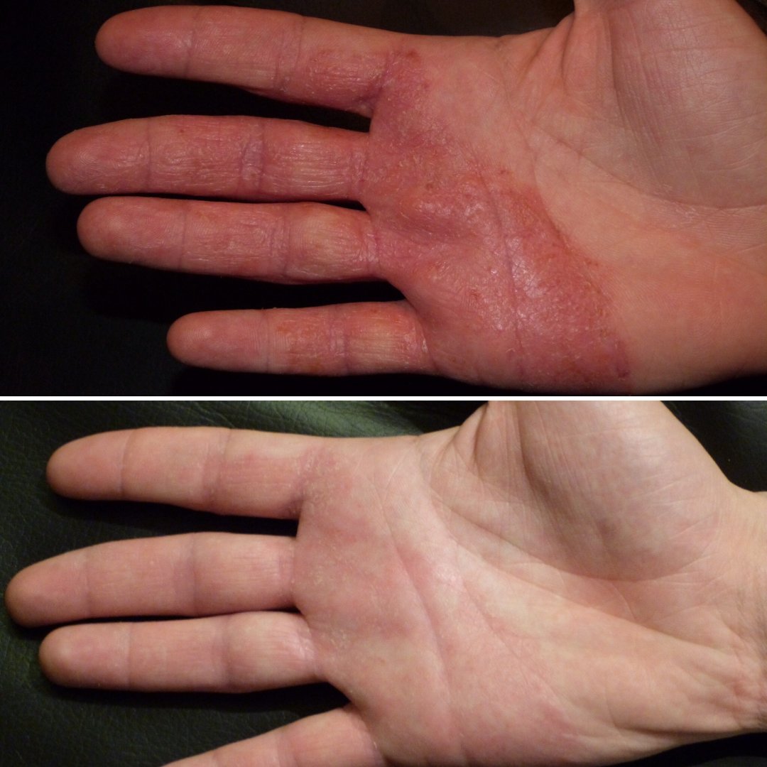 Dermalux Eczema Before and After Hands.jpg