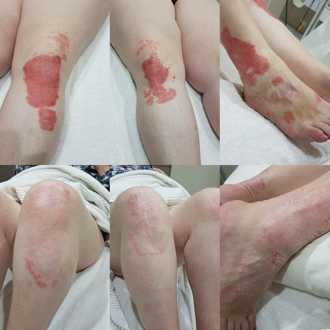 Dermalux Psoriasis Before and After 20 Sessions.jpg