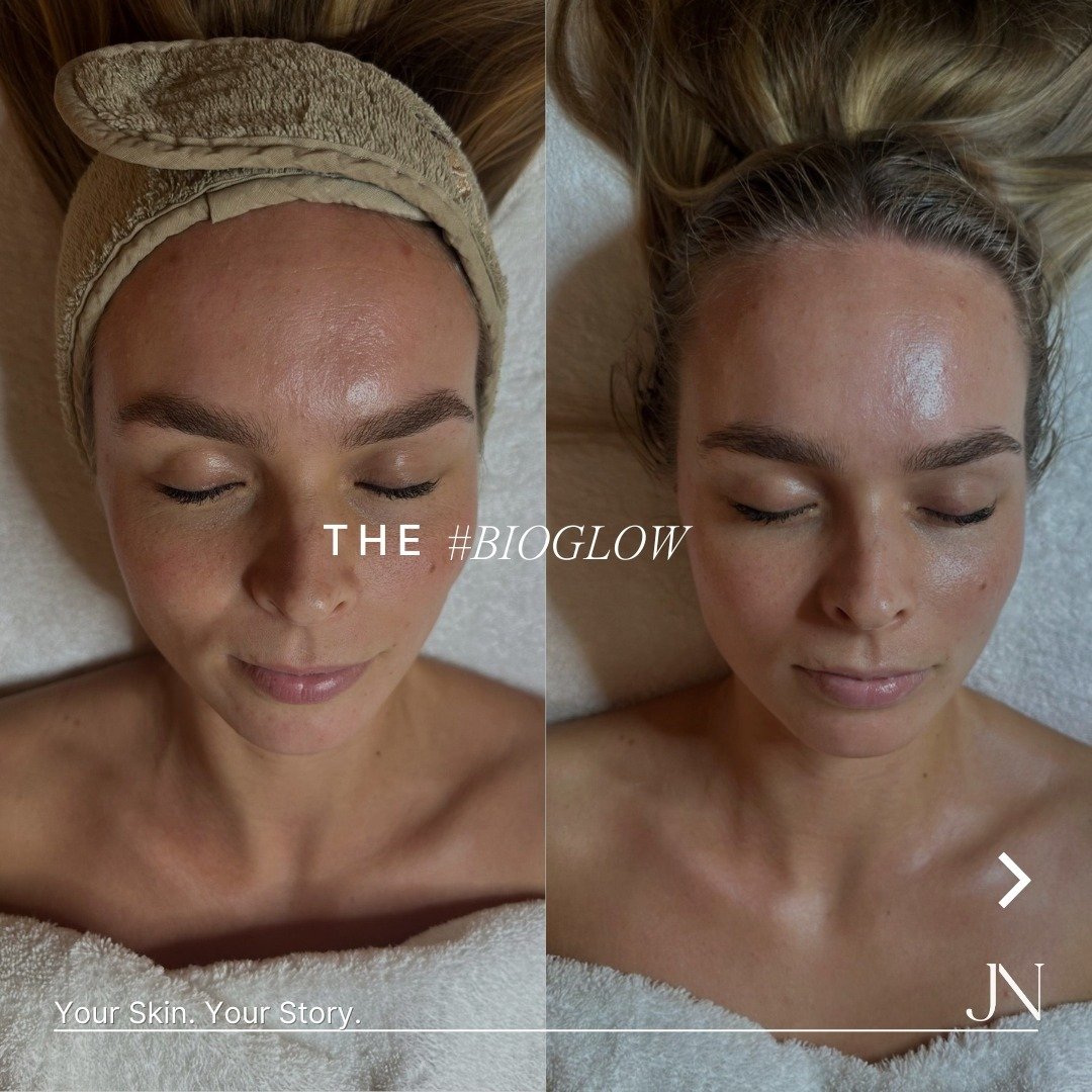 THE BIO GLOW ✨

Here are some of our latest results from our famous and the signature Biologique Recherche Soin Restructurant et Lissant Facial Treatment &hellip;

✨Instant Definition
✨Sculpting and Toning
✨Restoring Barrier
✨Reducing Textural Irregu