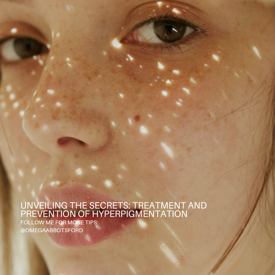 Unveiling the Secrets: Treatment and Prevention of Hyperpigmentation