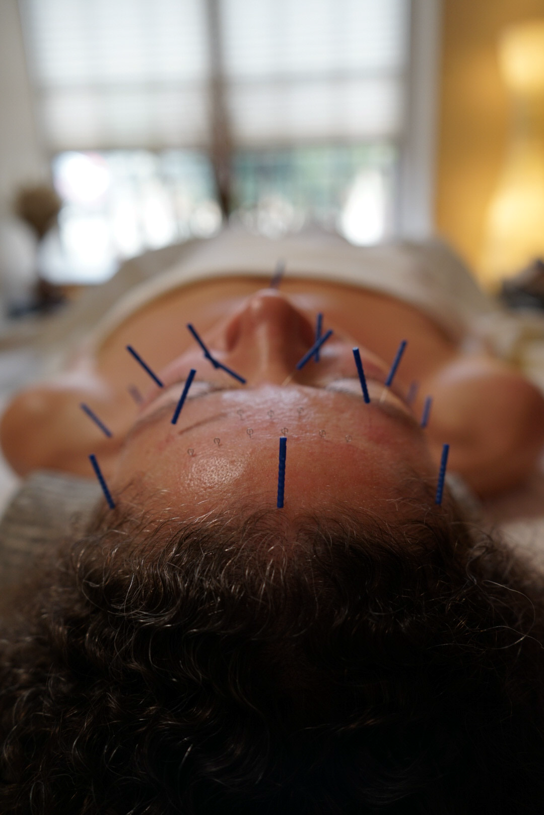 A person lying down with multiple acupuncture needles inserted into their face, viewed from below, in a clinic or treatment room.