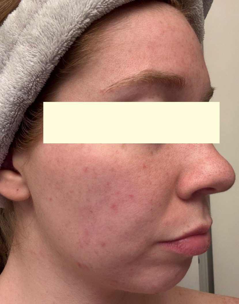 Naturopathic and holistic acne doctor Dr. Sheyda Vadipour helps you heal your acne naturally and achieve clear skin through functional lab testing, hormone and gut healing, and root-cause medicine.