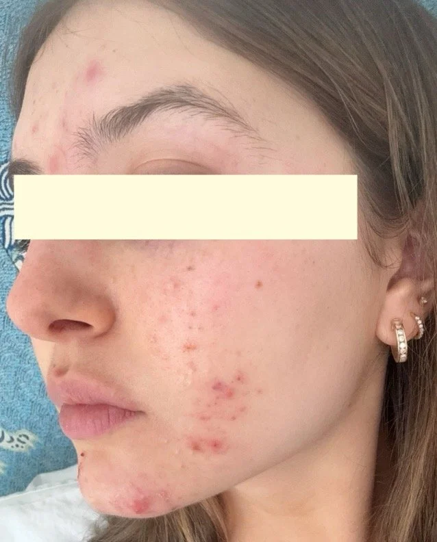 Naturopathic and holistic acne doctor Dr. Sheyda Vadipour helps you heal your acne naturally and achieve clear skin through functional lab testing, hormone and gut healing, and root-cause medicine.