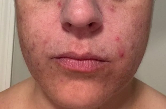 Naturopathic and holistic acne doctor Dr. Sheyda Vadipour helps you achieve lasting heal your acne naturally and achieve clear skin through functional lab testing, hormone and gut healing, and root-cause medicine.