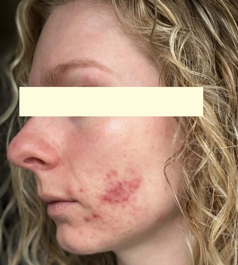 Naturopathic and holistic acne doctor, Dr. Sheyda Vadipour, helping you heal acne naturally and achieve clear skin through functional lab testing, hormone and gut healing, and root-cause medicine.