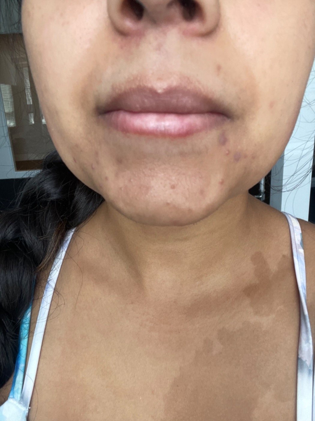 Close-up photograph of a person's lower face, showing lips and chin with some skin blemishes and dark spots.