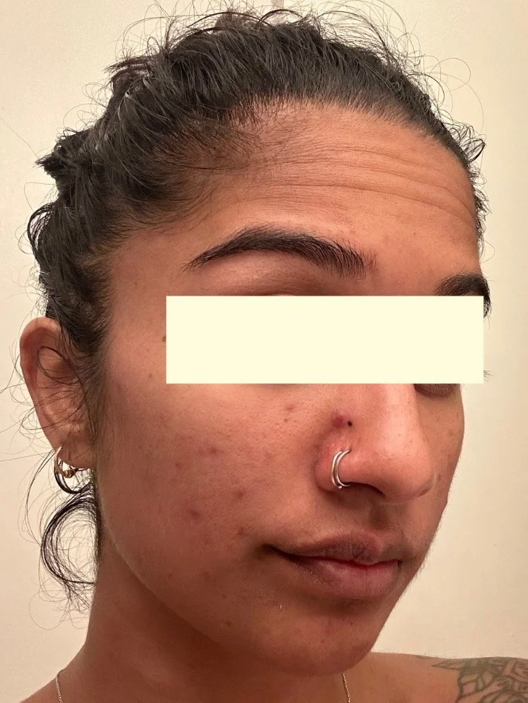 Naturopathic and holistic acne doctor Dr. Sheyda Vadipour helps you heal your acne naturally and achieve clear skin through functional lab testing, hormone and gut healing, and root-cause medicine.