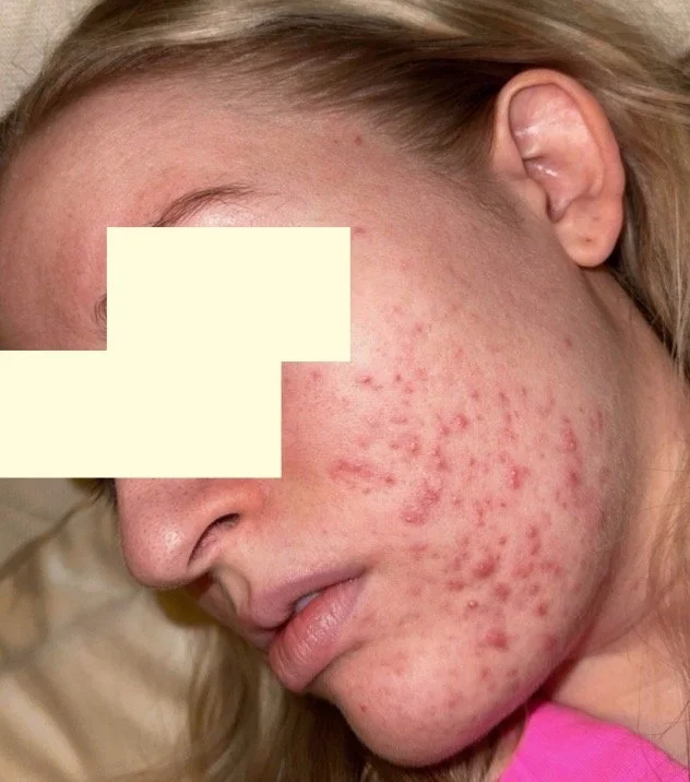 Close-up of a young woman's face showing acne and skin redness, with her eye and part of her face partially obscured.