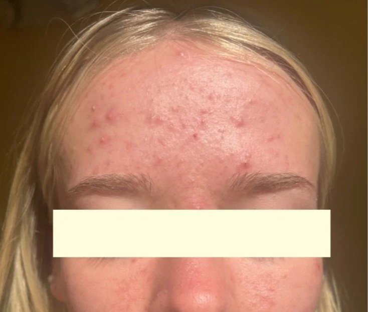 Naturopathic and holistic acne doctor Dr. Sheyda Vadipour helps you heal your acne naturally and achieve clear skin through functional lab testing, hormone and gut healing, and root-cause medicine.