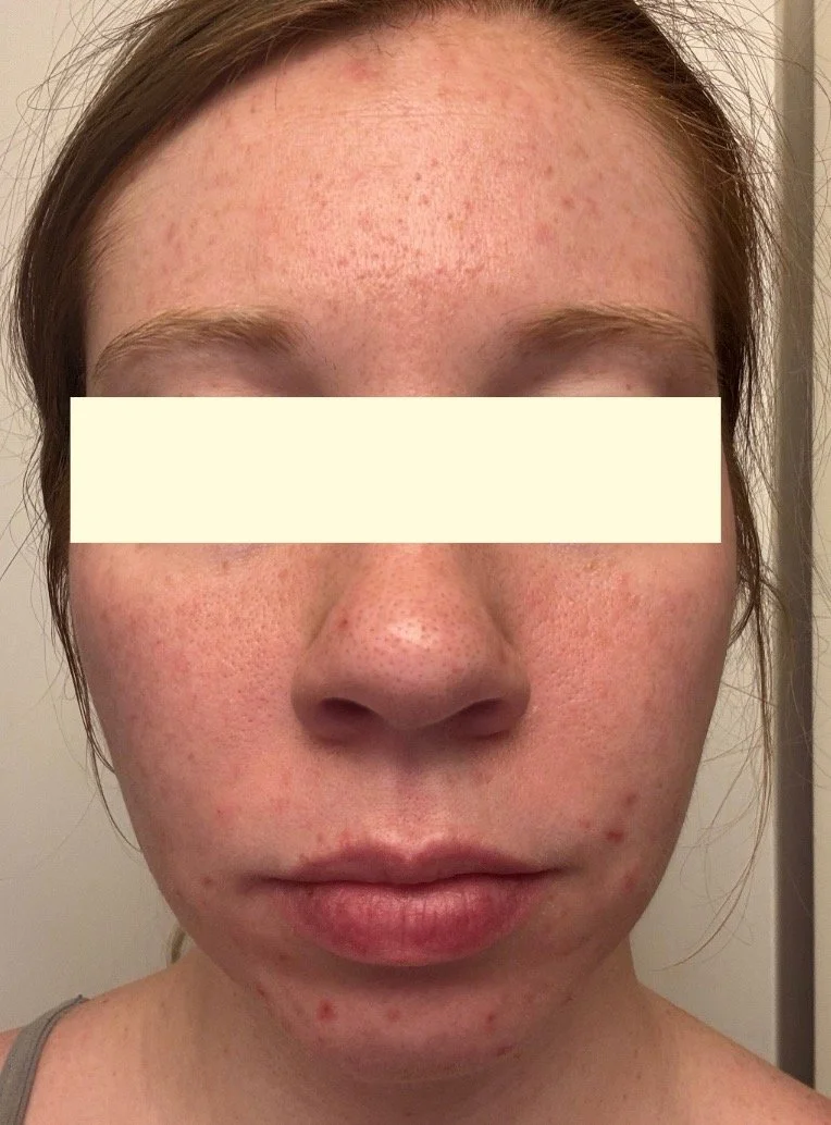 Naturopathic and holistic acne doctor Dr. Sheyda Vadipour helps you heal your acne naturally and achieve clear skin through functional lab testing, hormone and gut healing, and root-cause medicine.