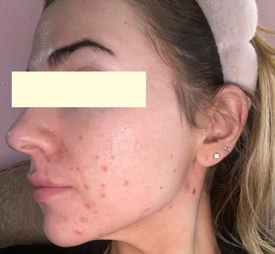 Naturopathic and holistic acne doctor, Dr. Sheyda Vadipour, helping you heal acne naturally and achieve clear skin through functional lab testing, hormone and gut healing, and root-cause medicine.