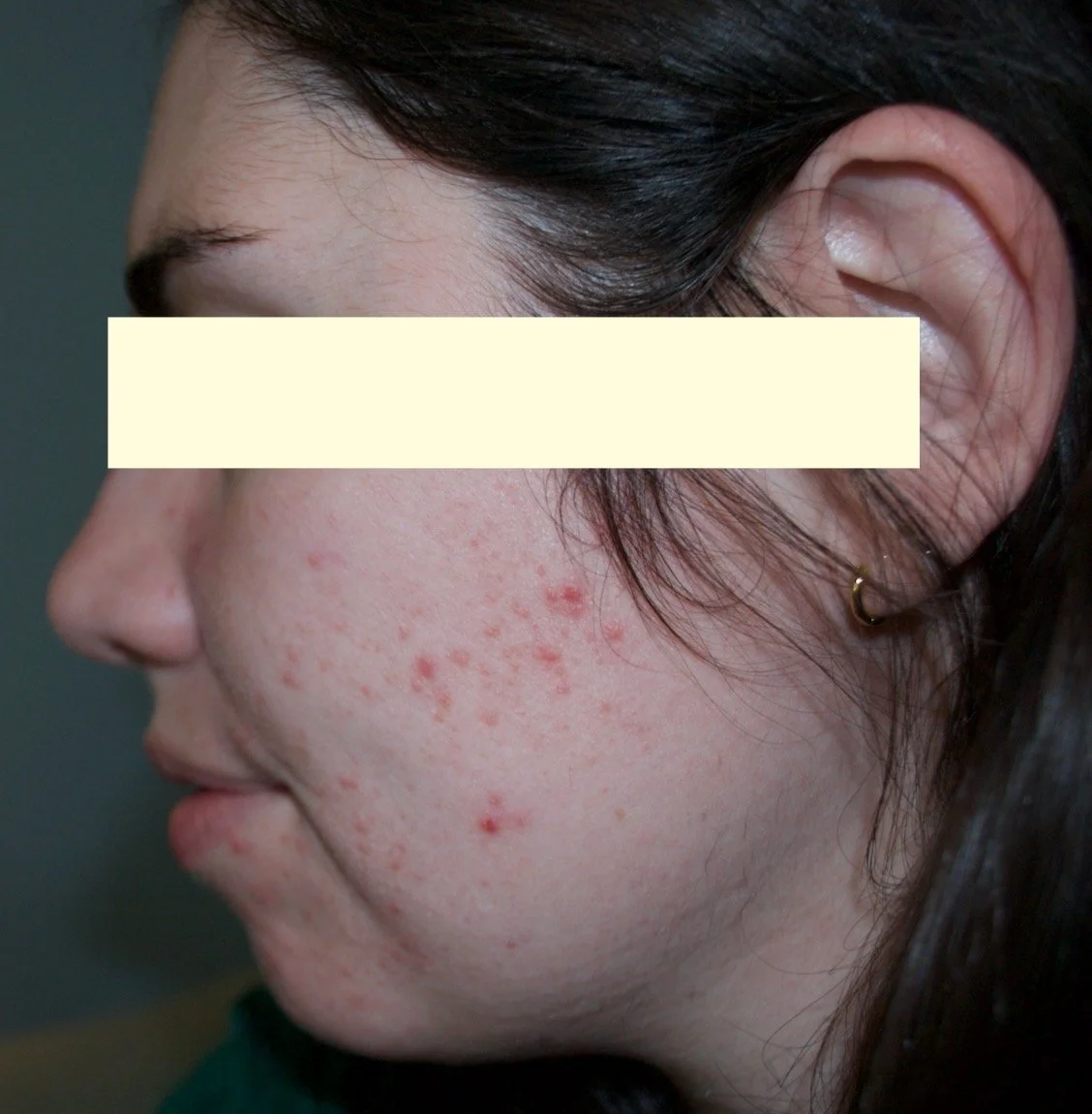 Naturopathic and holistic acne doctor Dr. Sheyda Vadipour helps you heal your acne naturally and achieve clear skin through functional lab testing, hormone and gut healing, and root-cause medicine.