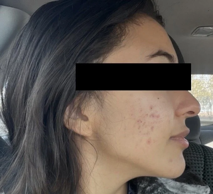 Naturopathic and holistic acne doctor Dr. Sheyda Vadipour helps you heal your acne naturally and achieve clear skin through functional lab testing, hormone and gut healing, and root-cause medicine.
