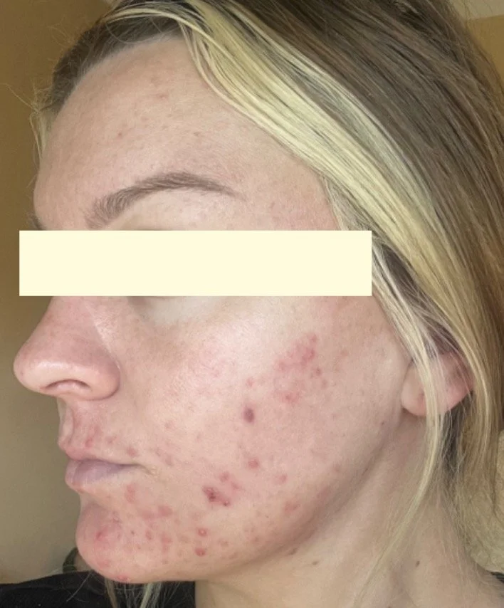 Naturopathic and holistic acne doctor, Dr. Sheyda Vadipour, helping you heal acne naturally and achieve clear skin through functional lab testing, hormone and gut healing, and root-cause medicine.