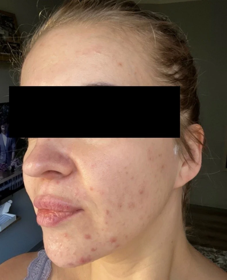Naturopathic and holistic acne doctor Dr. Sheyda Vadipour helps you achieve lasting clear skin through functional lab testing, hormone and gut healing, and root-cause medicine.