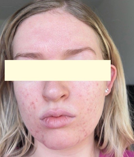Naturopathic and holistic acne doctor Dr. Sheyda Vadipour helps you heal your acne naturally and achieve clear skin through functional lab testing, hormone and gut healing, and root-cause medicine.