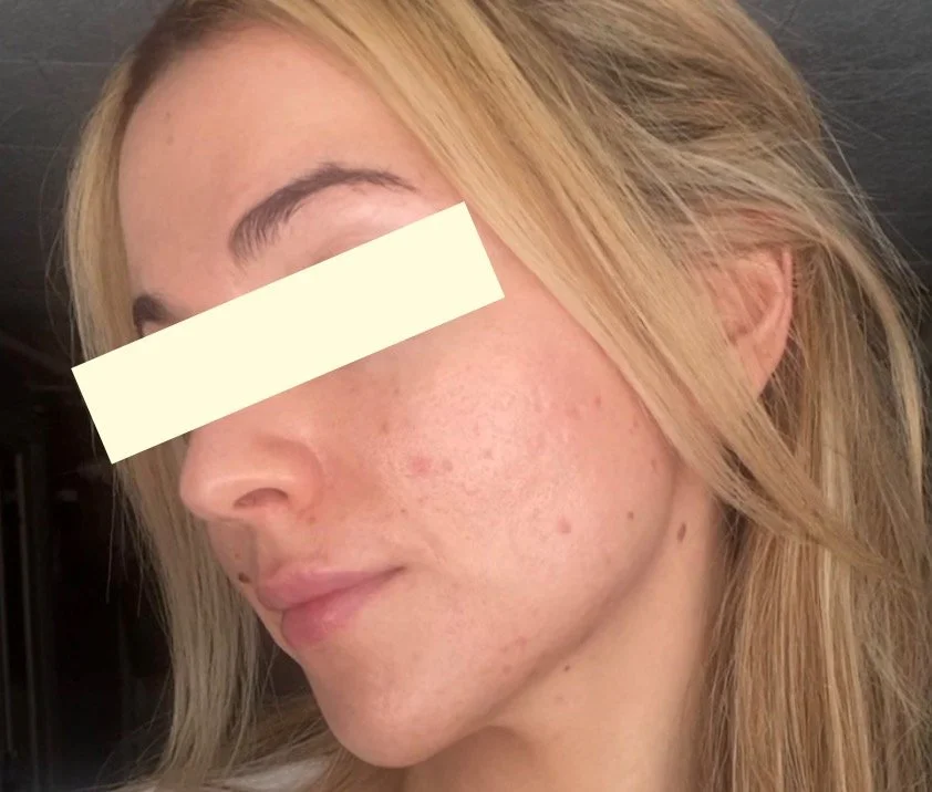 Naturopathic and holistic acne doctor, Dr. Sheyda Vadipour, helping you heal acne naturally and achieve clear skin through functional lab testing, hormone and gut healing, and root-cause medicine.