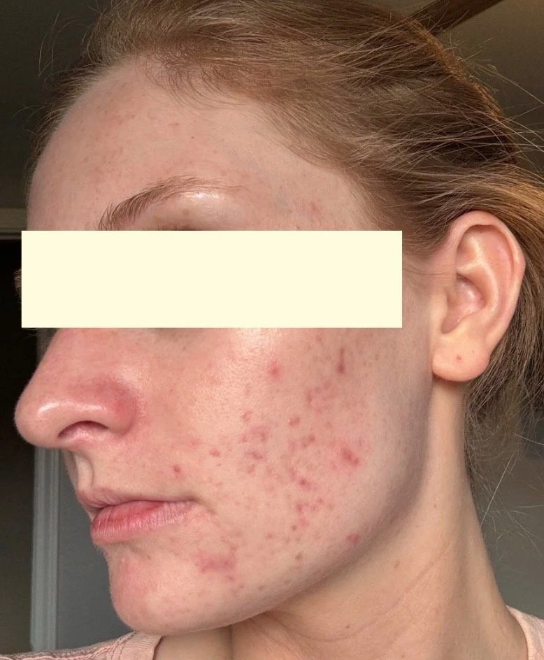 Naturopathic and holistic acne doctor, Dr. Sheyda Vadipour, helping you heal acne naturally and achieve clear skin through functional lab testing, hormone and gut healing, and root-cause medicine.