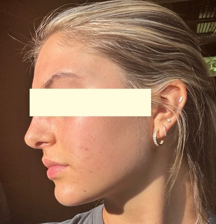 Naturopathic and holistic acne doctor Dr. Sheyda Vadipour helps you heal your acne naturally and achieve clear skin through functional lab testing, hormone and gut healing, and root-cause medicine.