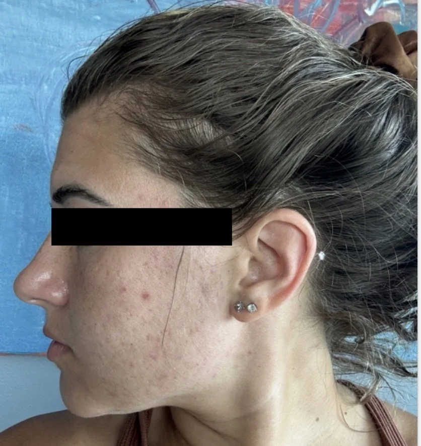 Naturopathic and holistic acne doctor Dr. Sheyda Vadipour helps you heal your acne naturally and achieve clear skin through functional lab testing, hormone and gut healing, and root-cause medicine.