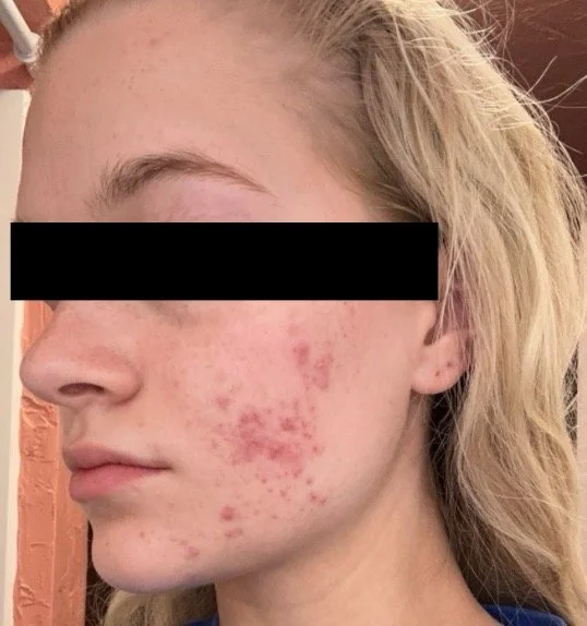 Naturopathic and holistic acne doctor Dr. Sheyda Vadipour helps you achieve lasting heal your acne naturally and achieve clear skin through functional lab testing, hormone and gut healing, and root-cause medicine.