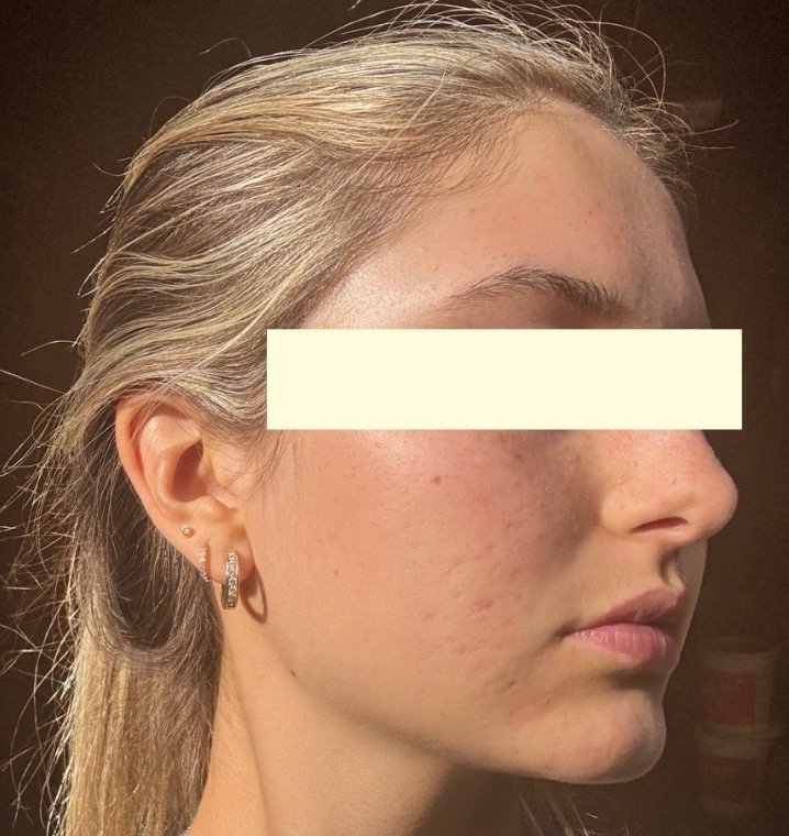 Naturopathic and holistic acne doctor Dr. Sheyda Vadipour helps you heal your acne naturally and achieve clear skin through functional lab testing, hormone and gut healing, and root-cause medicine.