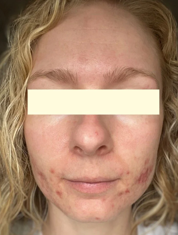 Naturopathic and holistic acne doctor, Dr. Sheyda Vadipour, helping you heal acne naturally and achieve clear skin through functional lab testing, hormone and gut healing, and root-cause medicine.